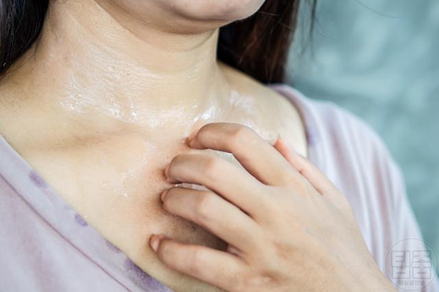 세로토닌 증후군 식은땀 발열