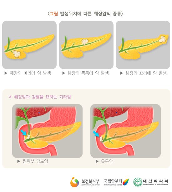 췌장암
