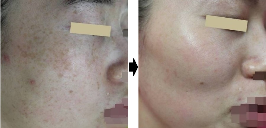 큐스위치 시술전후