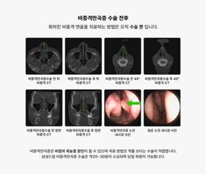비중격 만곡증