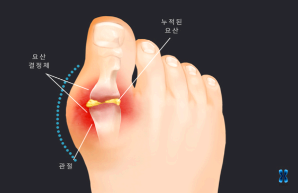 엄지발가락-요산-결정체를-표시한-발-그림-이미지