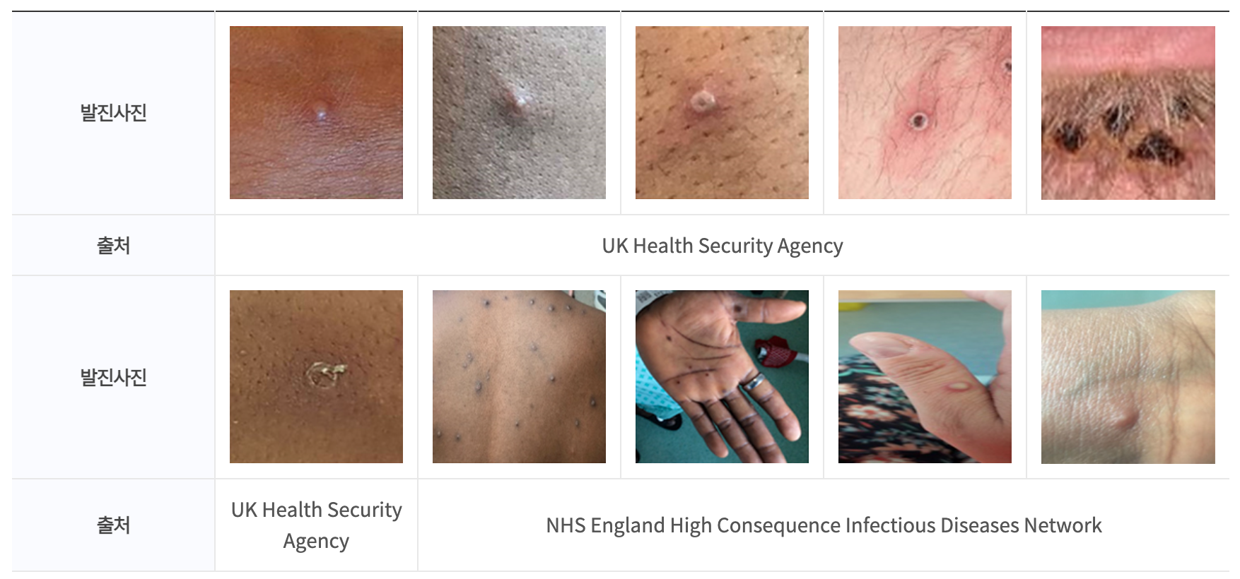 원숭이 두창 (엠폭스) - 증상