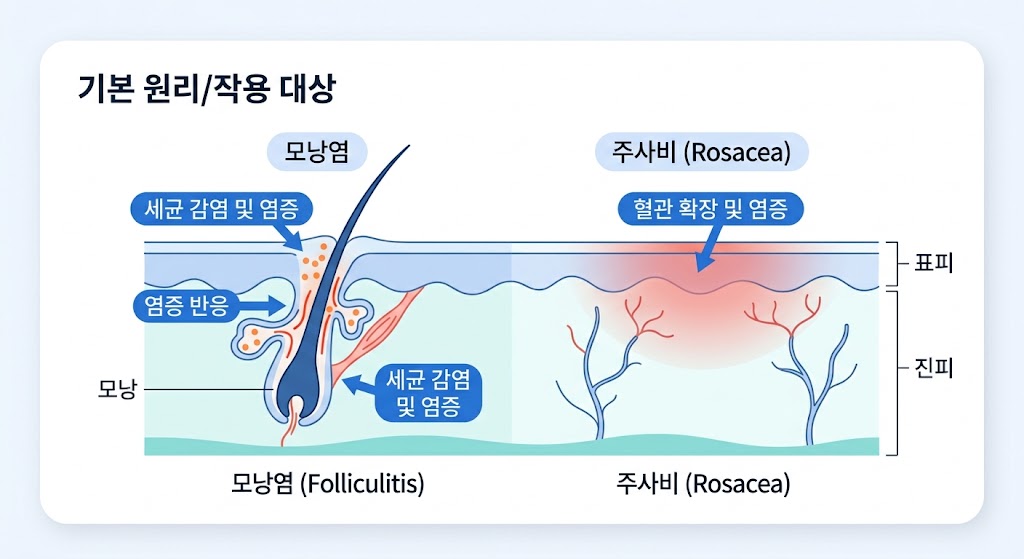 단순 여드름과 염증성 질환(모낭염&middot;주사비)의 피부 단면 작용 대상 및 염증 반응 차이를 보여주는 깔끔한 인체 단면도 도식 다이어그램