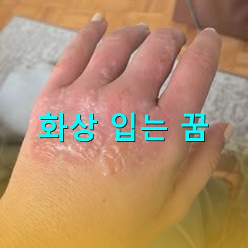 뜨거운-물을-손등에-부어-2도화상을-입은-모습