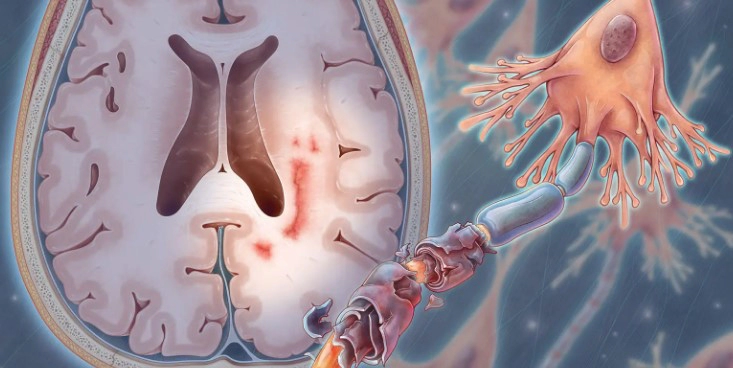 다발성 경화증 원인