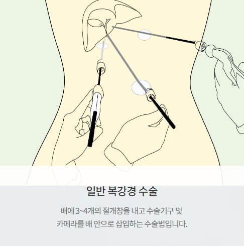 담석 수술방법 - 일반 복강경 수술