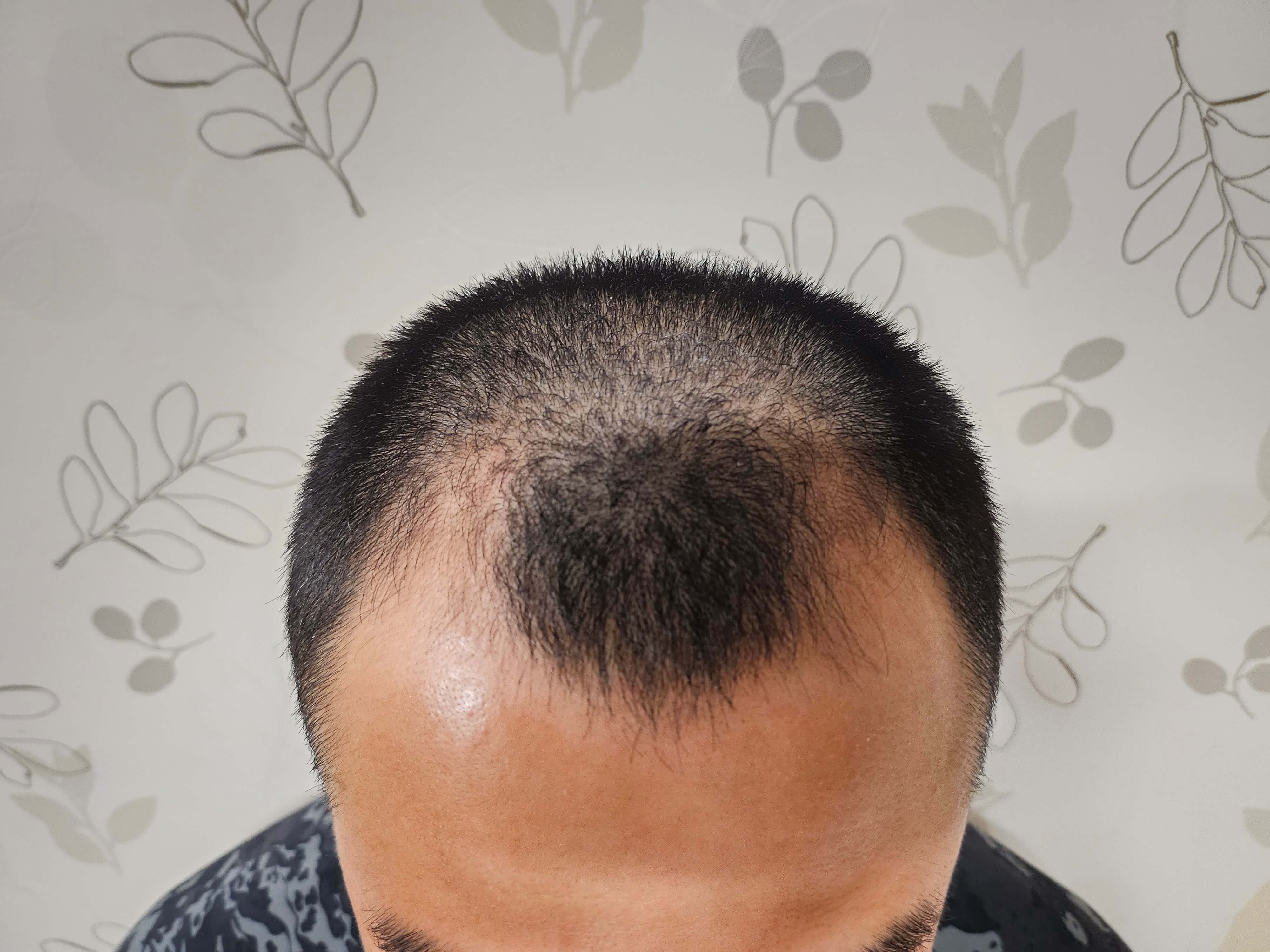 M자 탈모-전두부 탈모