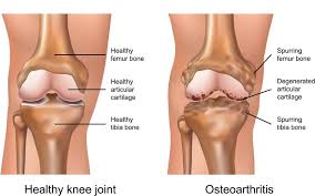 2025년 최신 무릎 연골 주사 종류 비교
