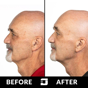 Jawzrsize 업체에서 홍보하는 턱운동 비포&애프터 사진