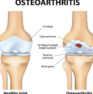 퇴행성 관절염 발현