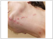 빈대 퇴치법과 효과적인 빈대 퇴치제