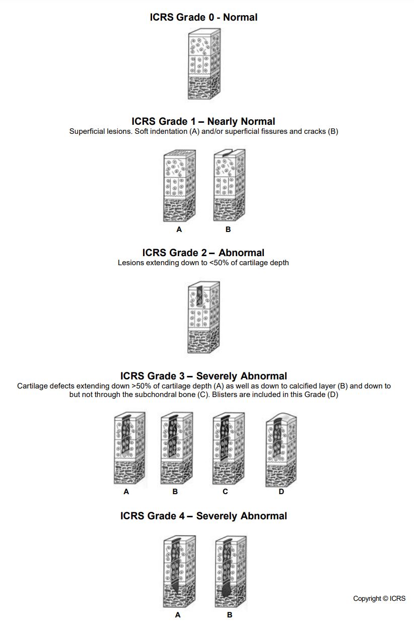 ICRS grade 구분 기준