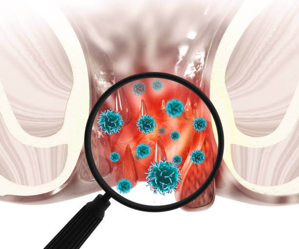 엉덩이 종기 원인과 관리하는 방법&amp;#44; 종기는 누구나 한 번쯤은 겪을 수 있는 흔한 질환이지만&amp;#44; 안일하다고 생각해서 치료를 하지 않는다면 삶의 질이 떨어질 수 있습니다. 특히 엉덩이 종기는 일상생활에 지장을 줄 수 있어 엉덩이 종기의 원인을 파악하고 병변에 맞는 치료를 진행하는 것이 매우 중요합니다. 참고해주세요.