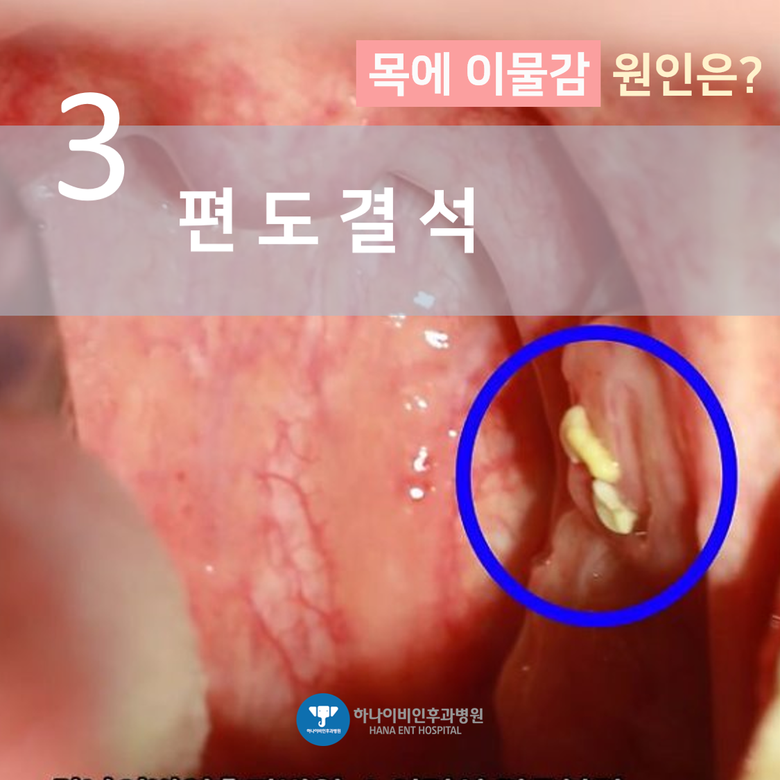 역류성 식도염 목 이물감&amp;#44; 가래가 낀 것처럼 느껴지는 이유