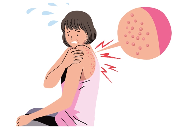 대상포진으로 생긴 수포