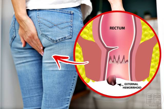 치질 자연치료 음식