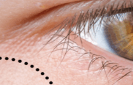 눈밑에 하얀 좁쌀