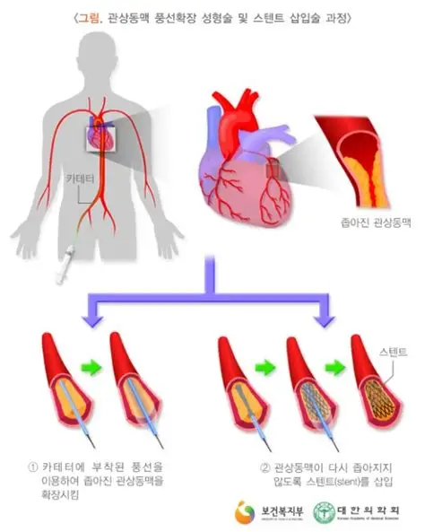 급성심근경색 증상·원인·치료 방법 ❤️ 심장 건강 상식