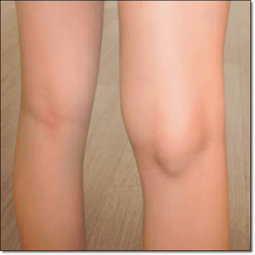 베이커낭종 증상