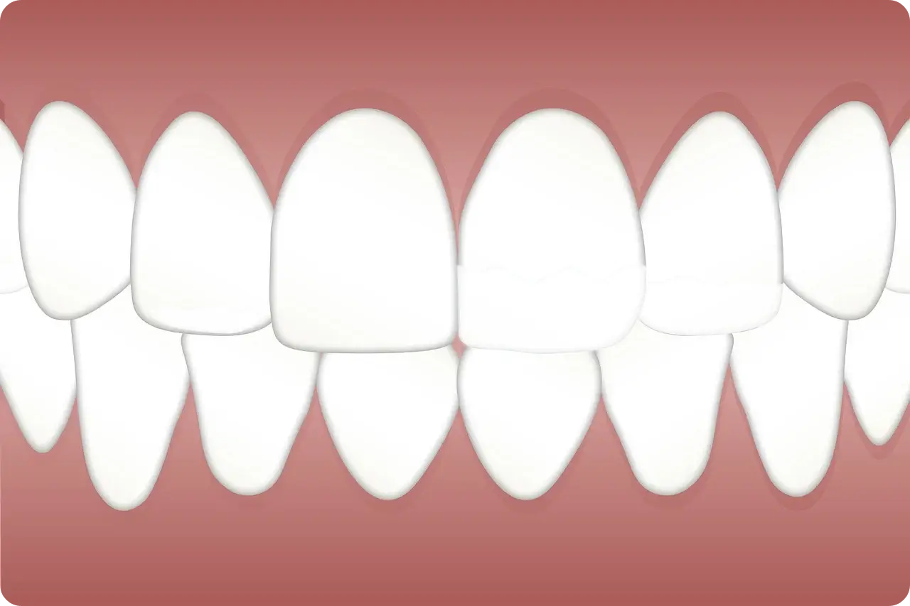 양치 후 물 마시지 마세요! 놓치기 쉬운 구강관리 팁