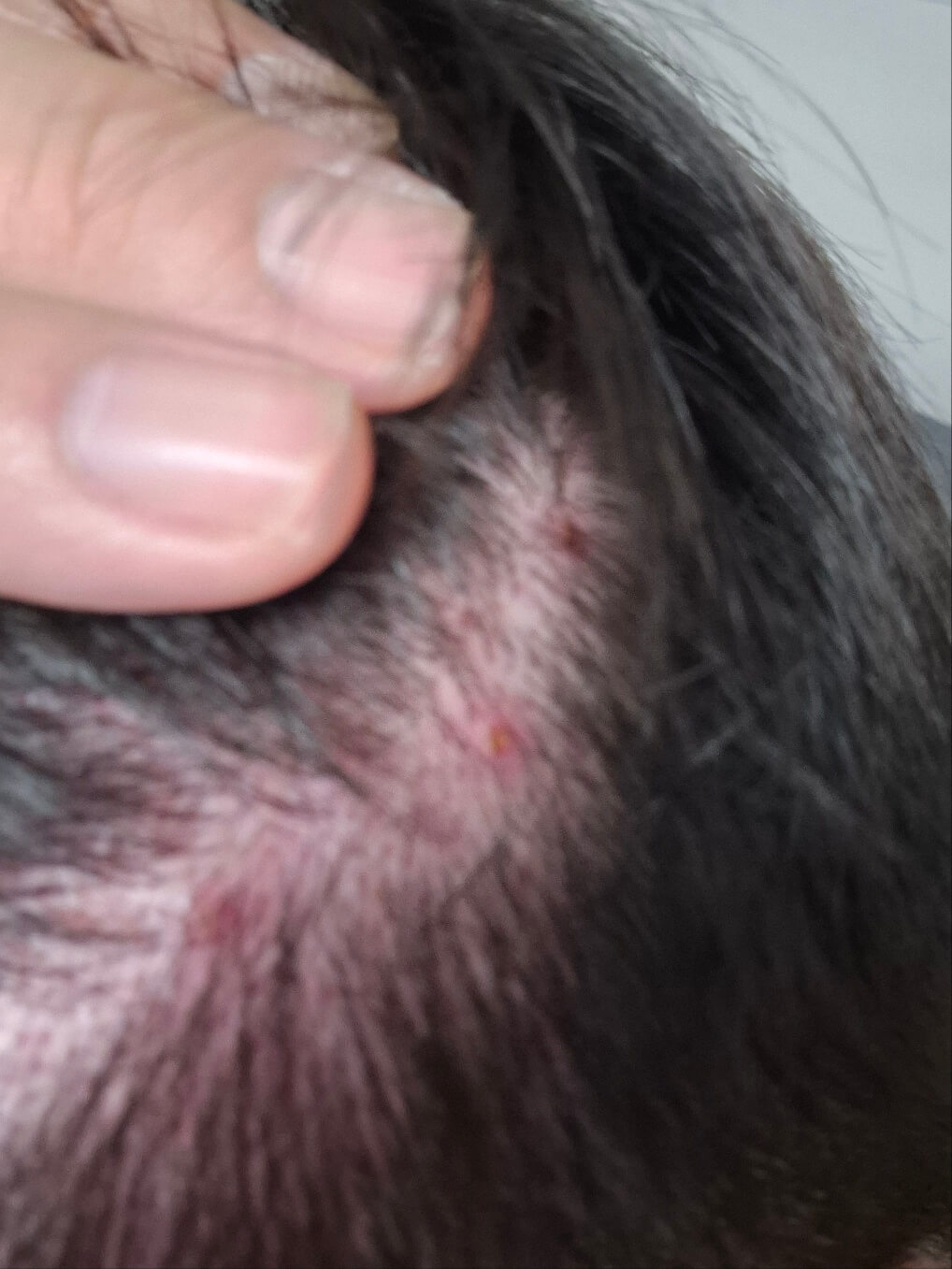 지루성 두피염으로 인한 붉은색 반점