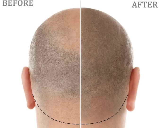 모발이식 3000모 비용