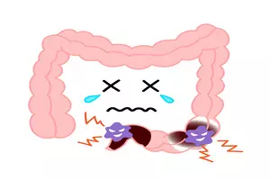 대장암 초기증상