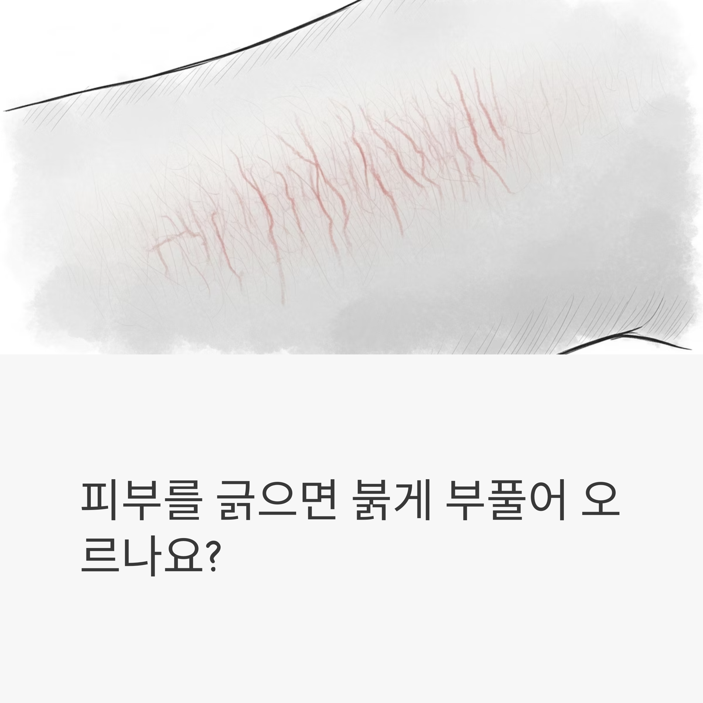 피부를 긁으면 붉게 부풀어 오르나요?
