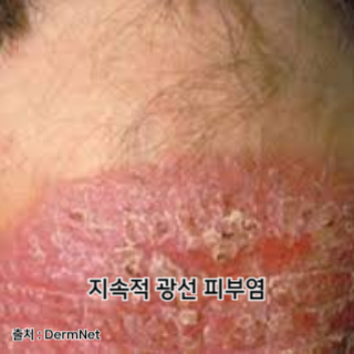 햇빛-알레르기-증상