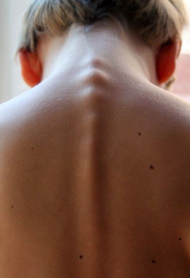 유아 척추측만증