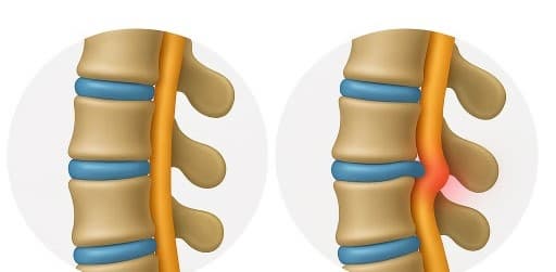 허리디스크 진단과 치료