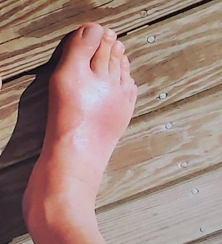 통풍 초기증상 통증 원인 통풍에 좋은 음식과 안 좋은 음식