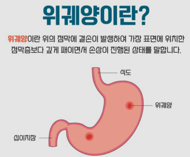 위궤양이란
