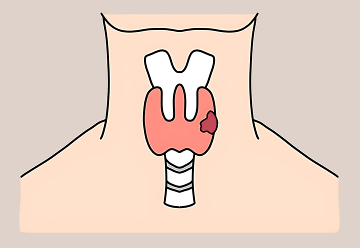 갑상선-암의-모습