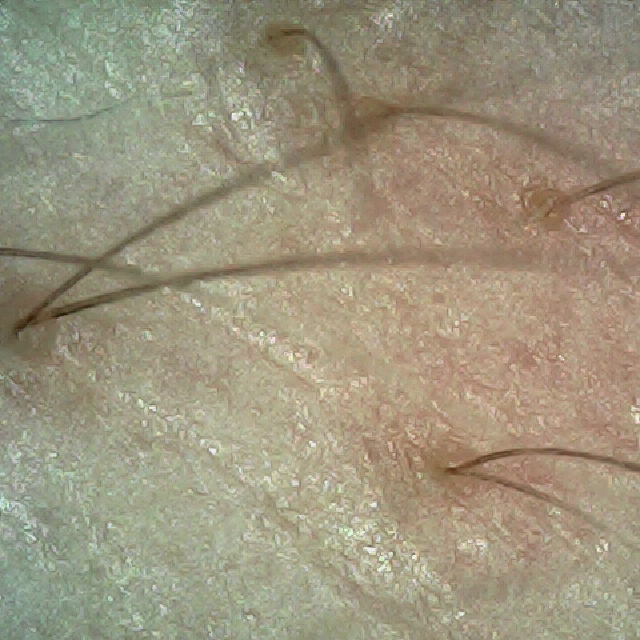 탈모 극복 프로젝트 - 오른쪽 M자 부위 두피 모습이다.