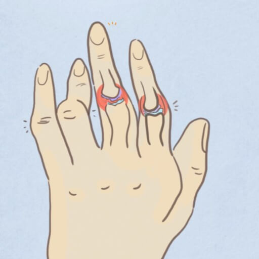 류마티스 관절염 초기증상