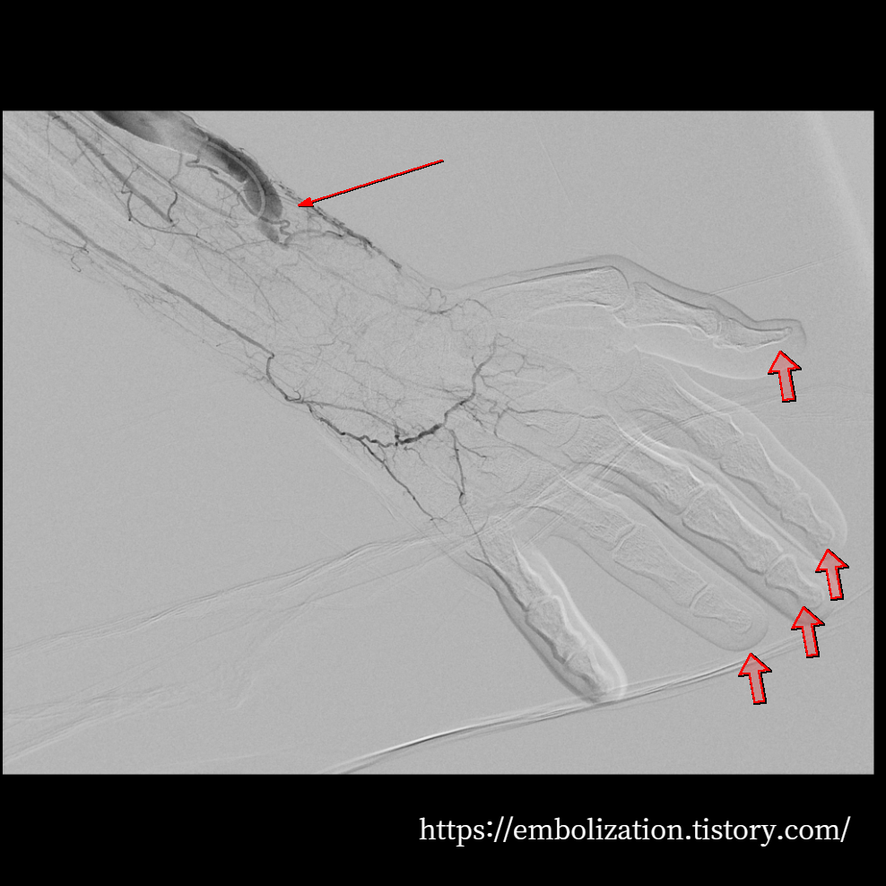 Steal syndrome due to steal syndrome combined with brachial artery stenosis
