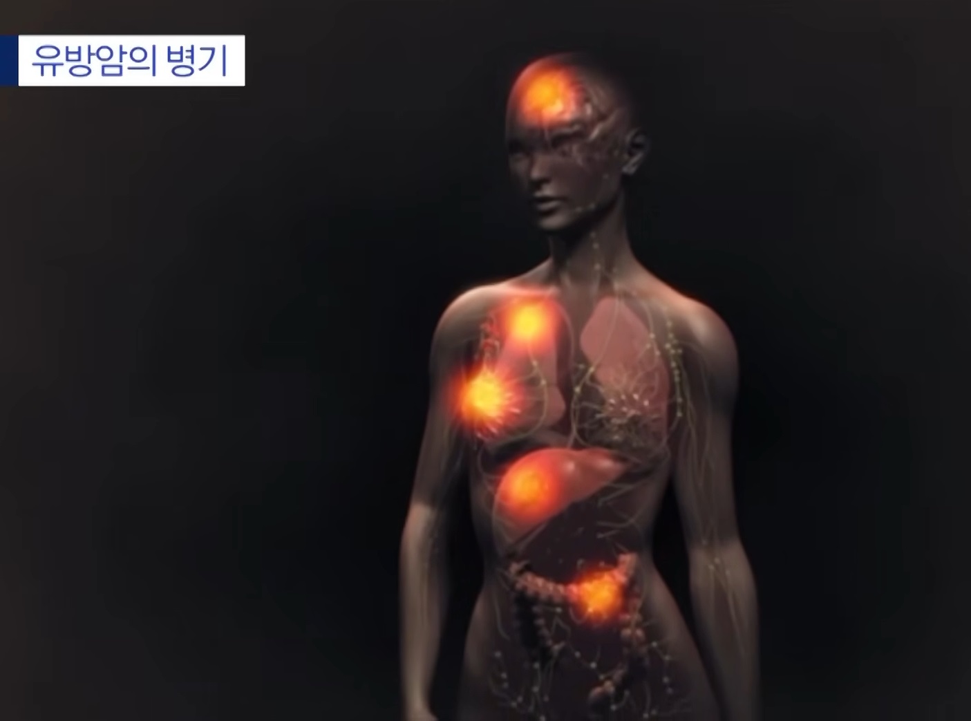 유방암-명의-우상욱-교수