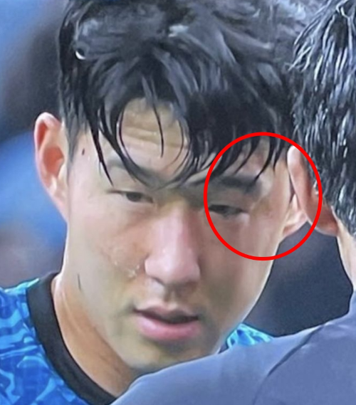 손흥민 수술 확정 안와골절 월드컵