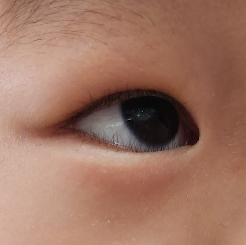 아래 속눈썹이 눈을 찌르는 모습