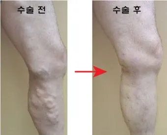 하지 정맥류 증상 치료방법과 예방 생활습관_6