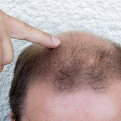 가을철 두피 가려운증 원인 파헤치기