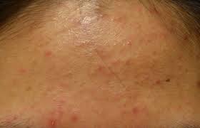 지루성 피부염 완치하려면