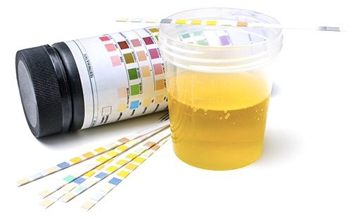 소변 침사 검사 (Urine Sediment Test)