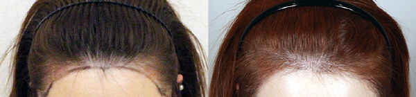 모발이식 3000모 비용