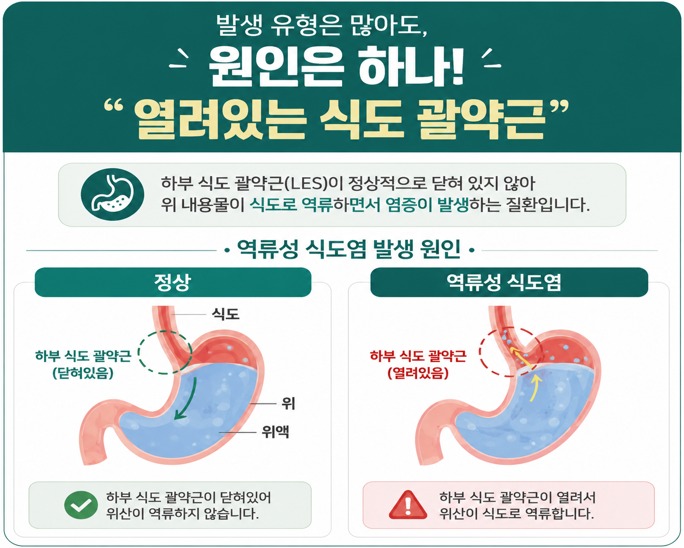 역류성 식도염의 원인설명