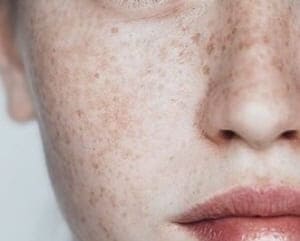 주근깨
