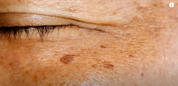 아연 영양제 추천