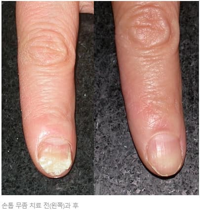 손톱무좀