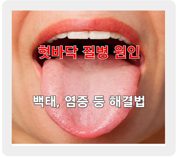 혓바닥 질병, 백태부터 염증까지 &ndash; 원인과 해결법 총정리